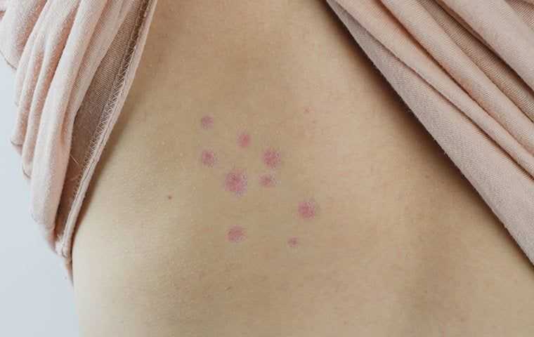 a person with bed bug bites on their back